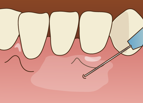 芦屋のBio Dental Clinic ASHIYAでは細い注射針を使用することで痛みのない無痛治療を行っています