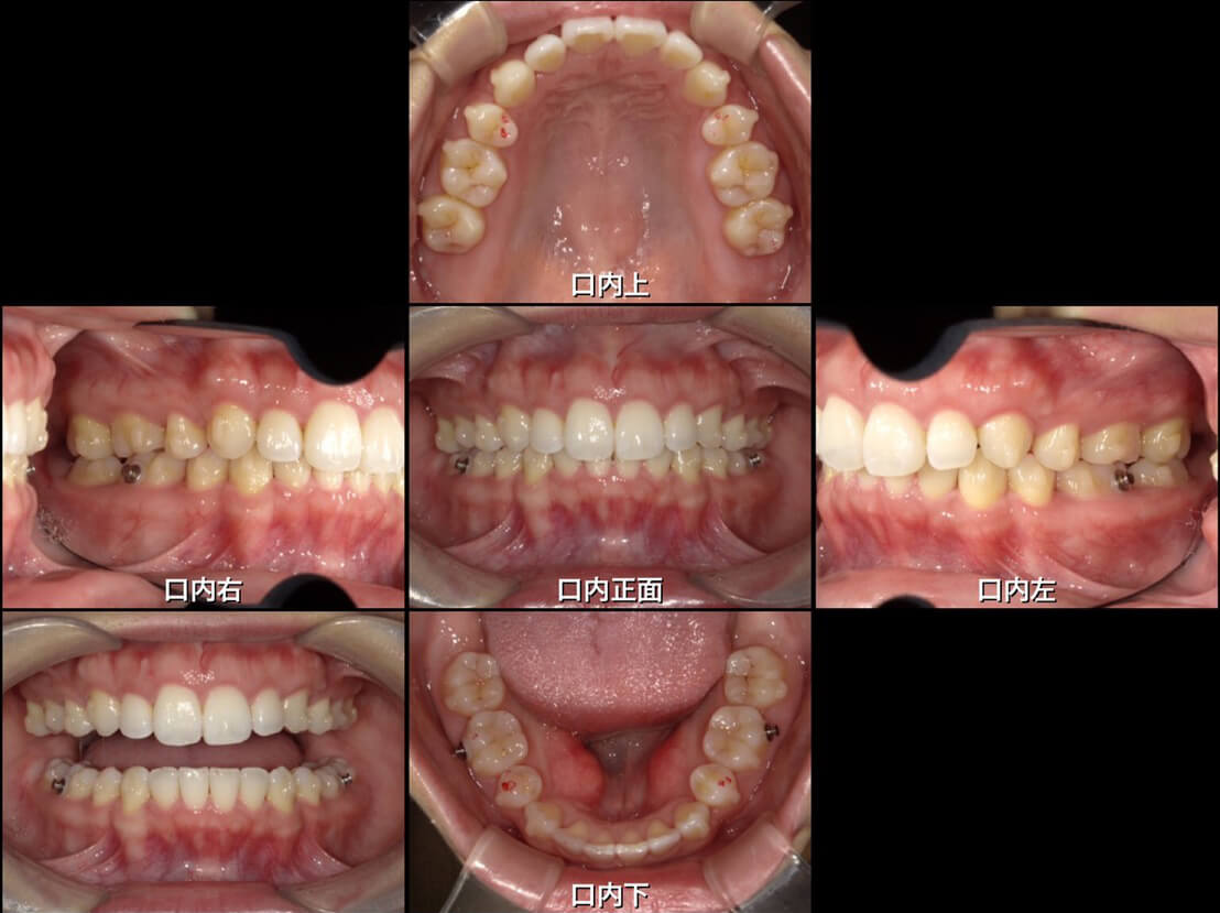 インビザライン矯正の症例