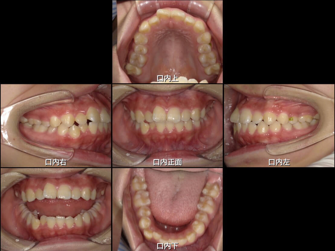 インビザライン矯正の症例