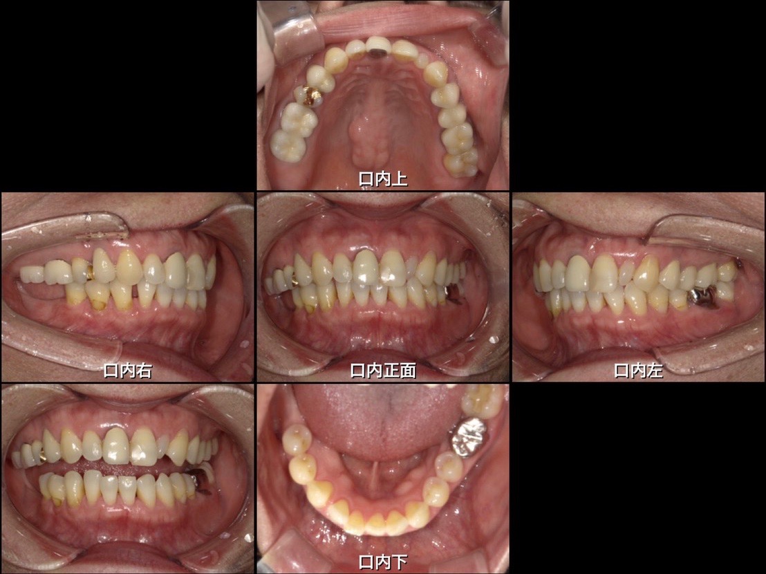 インプラント手術前