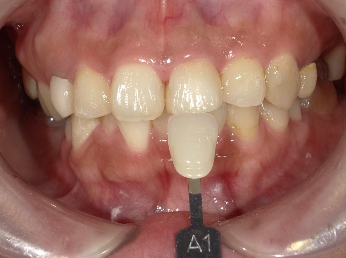 ホワイトニング治療後